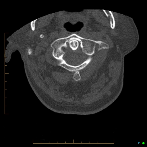 Cervical spine fracture - ankylosing spondylitis (Radiopaedia 76835-88706 Axial bone window 31).jpg