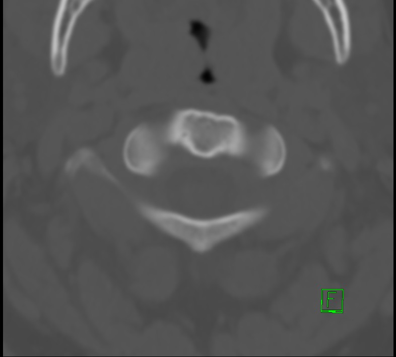 Cervical spine fracture - hyperflexion injury (Radiopaedia 66184-75364 Axial bone window 2).jpg
