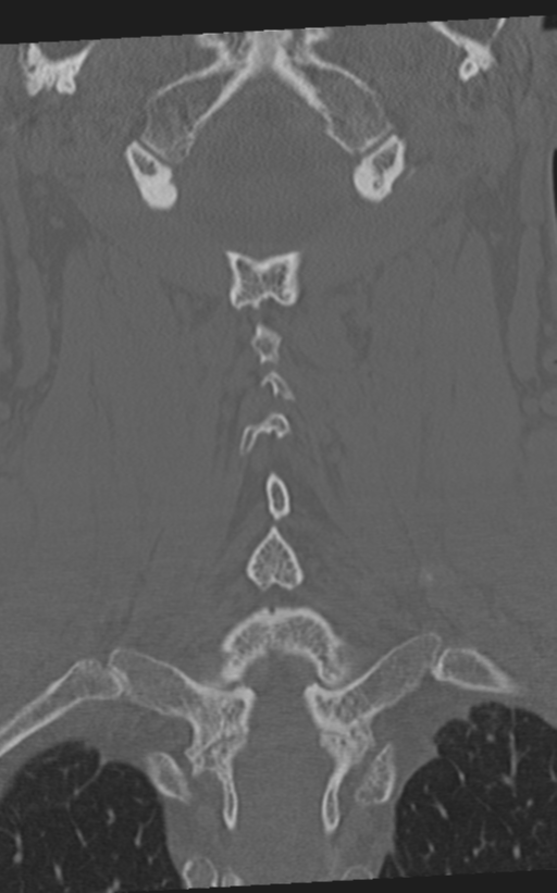 Cervical spine fractures with vertebral artery dissection (Radiopaedia 53296-59268 Coronal bone window 46).png