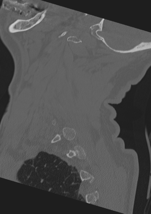 Cervical spine fractures with vertebral artery dissection (Radiopaedia 53296-59268 Sagittal bone window 10).png