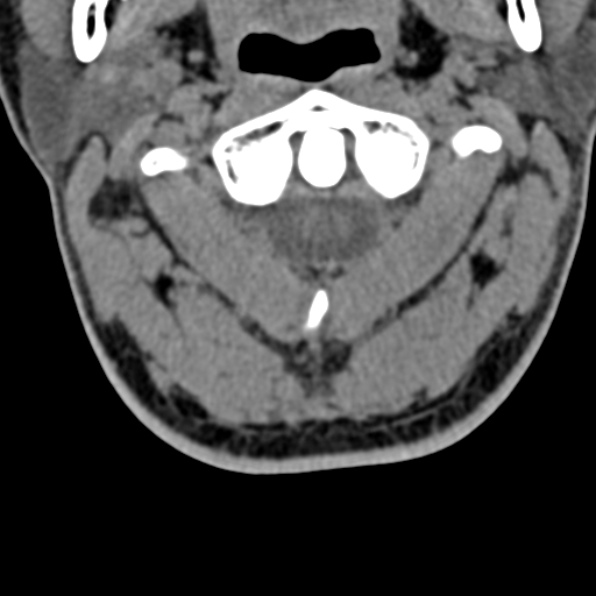 Cervical spondylodiscitis (Radiopaedia 28057-29489 Axial non-contrast 20).jpg