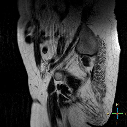 File:Cervical stump squamous cell carcinoma (Radiopaedia 48049-52858 Sagittal T2 1).jpg