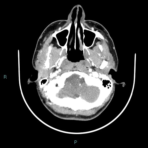 Cervical thymic cyst (Radiopaedia 88632-105335 B 102).jpg