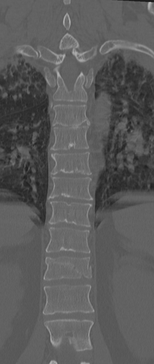 Chance fracture (Radiopaedia 33854-35020 Coronal bone window 49).png