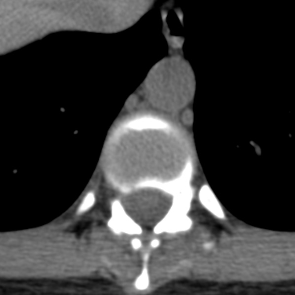 File:Chance fracture (Radiopaedia 36521-38081 Axial non-contrast 36).jpg