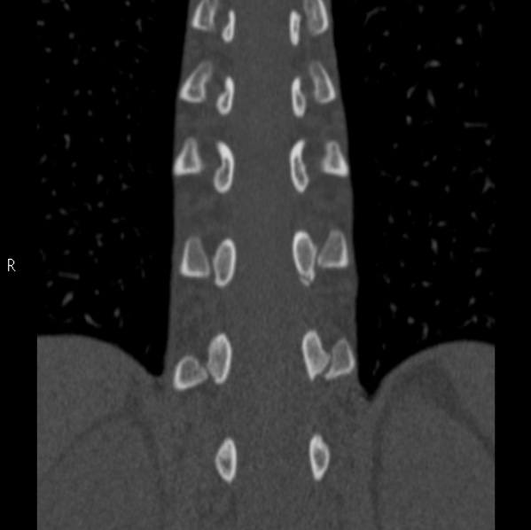 Chance fracture (Radiopaedia 36521-38081 Coronal bone window 38).jpg