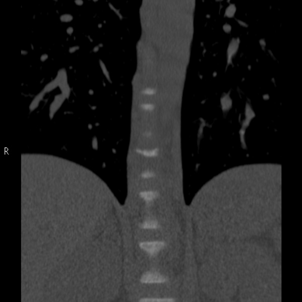 File:Chance fracture (Radiopaedia 36521-38081 Coronal bone window 4).jpg