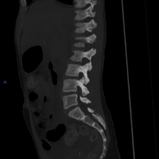 File:Chance fracture with duodenal and pancreatic lacerations (Radiopaedia 43477-50042 Sagittal bone window 17).jpg