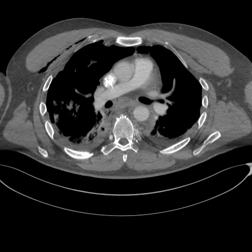 File:Chest multitrauma - aortic injury (Radiopaedia 34708-36147 A 137).png