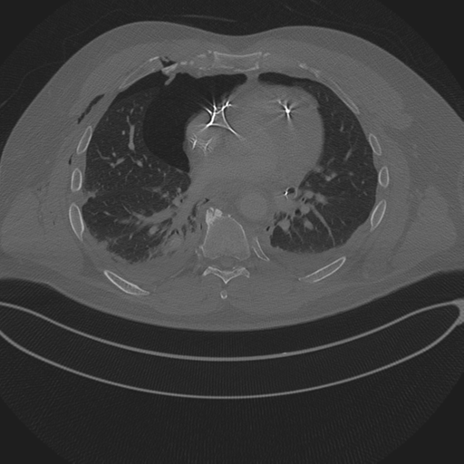 Chest multitrauma - aortic injury (Radiopaedia 34708-36147 Axial bone window 175).png