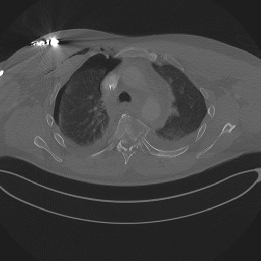 Chest multitrauma - aortic injury (Radiopaedia 34708-36147 Axial bone window 99).png