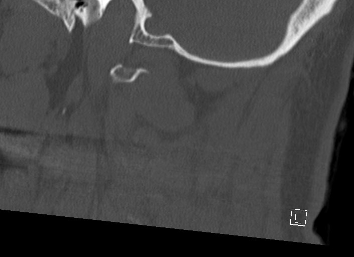 Chiari I malformation with a symptomatic syrinx of the posterolateral medulla oblongata (Radiopaedia 42573-45707 A 14).jpg