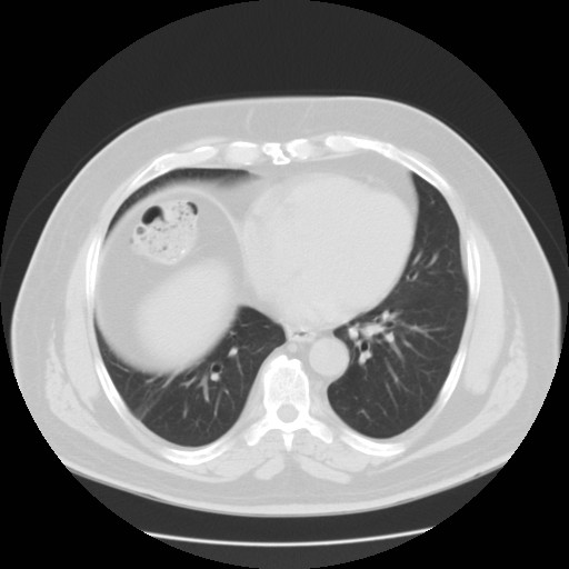 File:Chilaiditi’s syndrome (Radiopaedia 27550-27756 Axial lung window 8).jpg