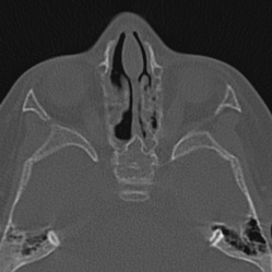 File:Choanal atresia (Radiopaedia 88525-105975 Axial bone window 60).jpg
