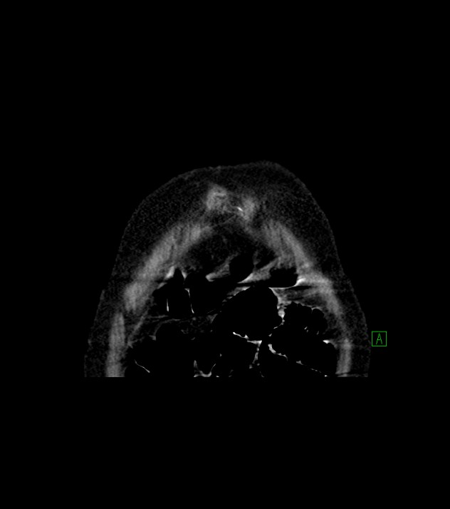 Cholangiocarcinoma with cerebral metastases (Radiopaedia 83519-98629 Coronal C+ delayed 3).jpg
