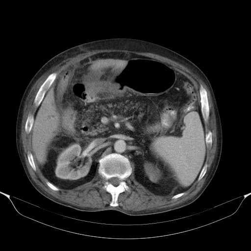 File:Cholangitis and abscess formation in a patient with cholangiocarcinoma (Radiopaedia 21194-21100 A 20).jpg