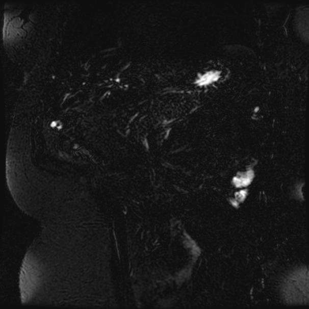 Choledocholithiasis on CT and MRI (Radiopaedia 24825-25088 Coronal T2 78).jpg