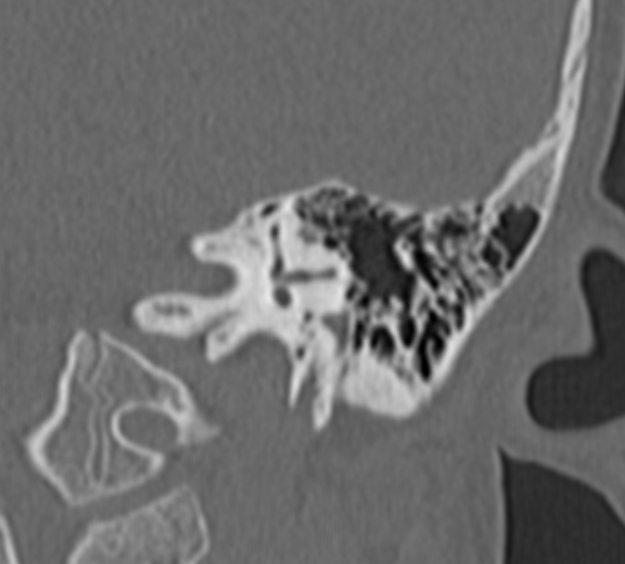 Cholesteatoma (Radiopaedia 73023-83750 Coronal Left ear 48).jpg