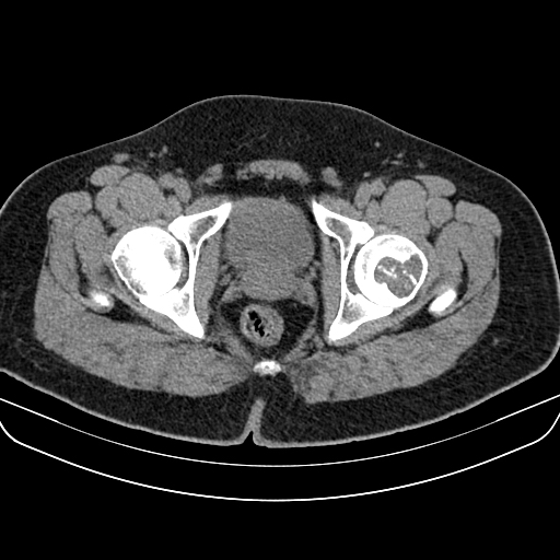 File:Chondroblastoma (Radiopaedia 12264-12563 Axial non-contrast 3).jpg