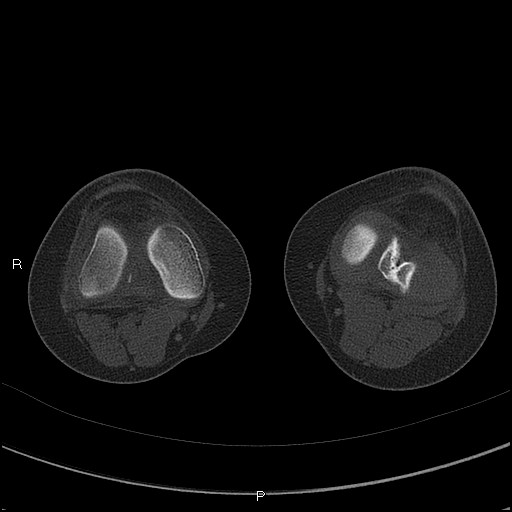 Chondroblastoma (Radiopaedia 62721-71030 Axial bone window 33).jpg