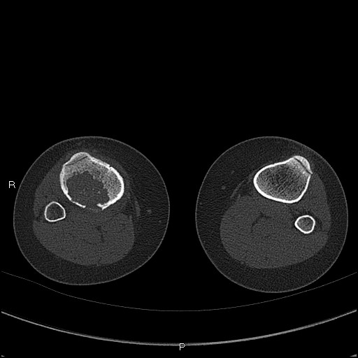 Chondroblastoma (Radiopaedia 62721-71030 Axial bone window 84).jpg