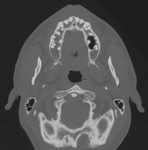 File:Chondrosarcoma (clivus) (Radiopaedia 46895-51425 Axial bone window 78).png