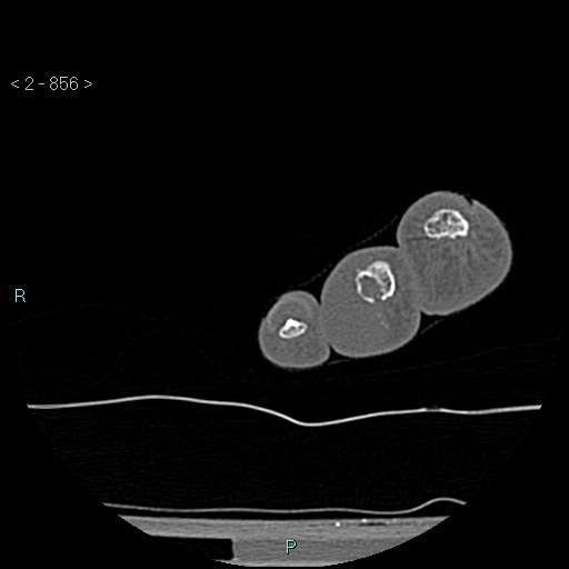 Chondrosarcoma - phalanx (Radiopaedia 69047-78812 Axial bone window 110).jpg