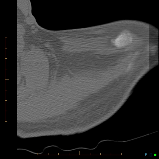 File:Chondrosarcoma of the scapula (Radiopaedia 30696-31399 Axial non-contrast 21).jpg
