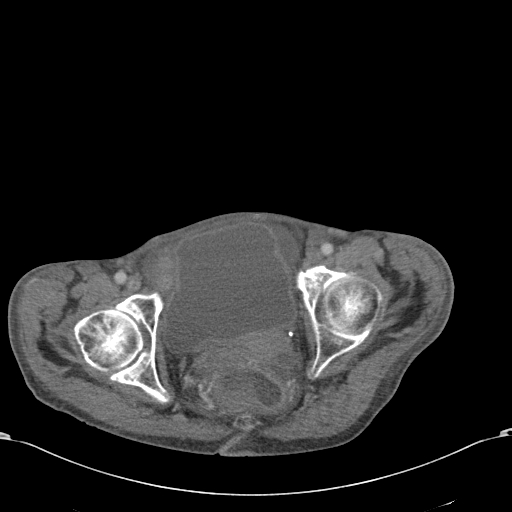 Chondrosarcoma of the spine (Radiopaedia 49871-55143 A 60).jpg