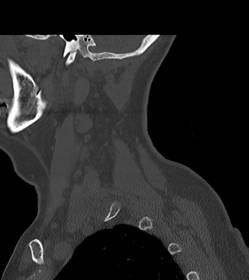 File:Chordoma (C4 vertebra) (Radiopaedia 47561-52188 Sagittal bone window 12).png