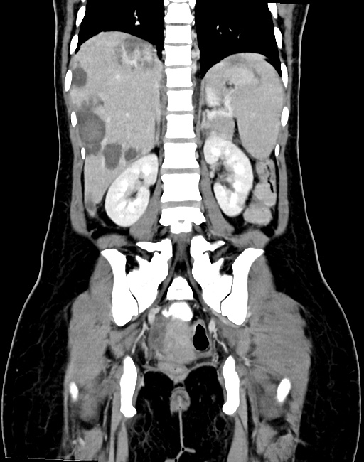 Choriocarcinoma liver metastases (Radiopaedia 74768-85766 B 68).jpg