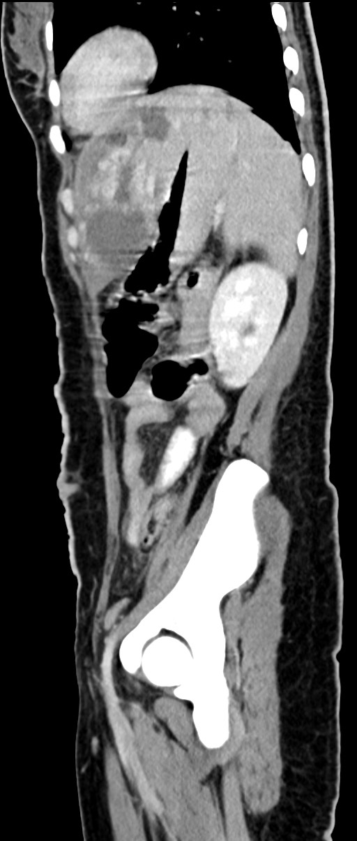 Choriocarcinoma liver metastases (Radiopaedia 74768-85766 C 66).jpg