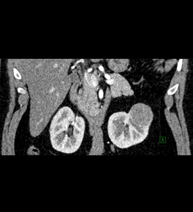Chromophobe renal cell carcinoma (Radiopaedia 84286-99573 E 28).jpg