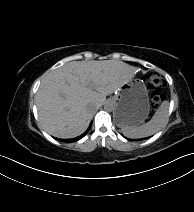 Chromophobe renal cell carcinoma (Radiopaedia 84290-99582 Axial non-contrast 28).jpg