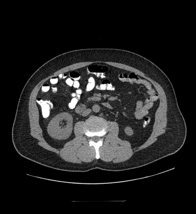 Chromophobe renal cell carcinoma (Radiopaedia 84337-99644 Axial non-contrast 51).jpg