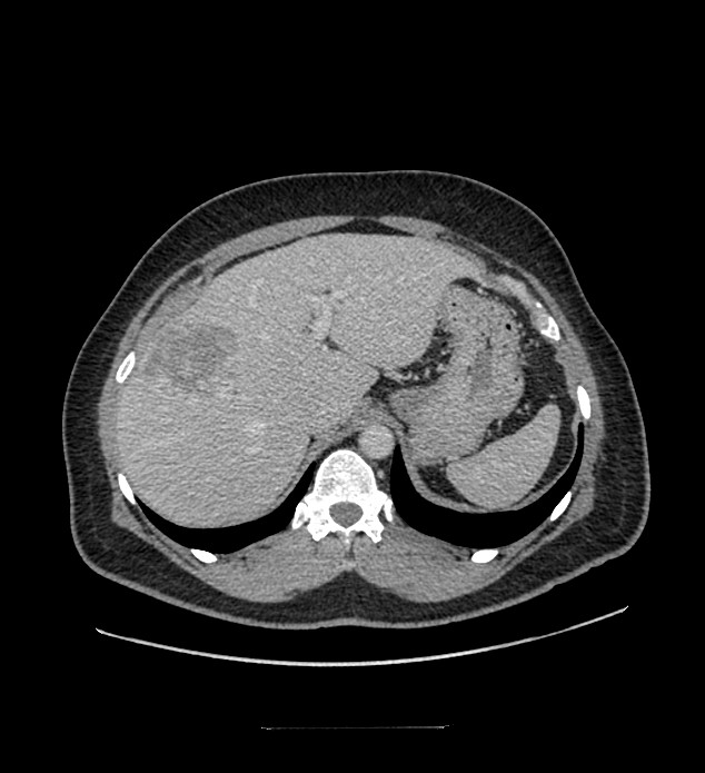 Chromophobe renal cell carcinoma (Radiopaedia 84337-99644 C 30).jpg