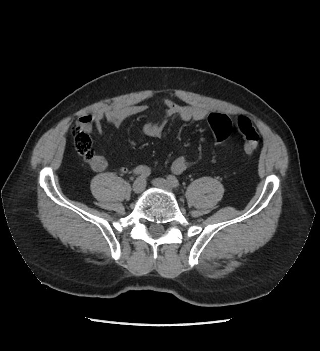 Chromophobe renal cell carcinoma (Radiopaedia 86879-103083 Axial non-contrast 84).jpg
