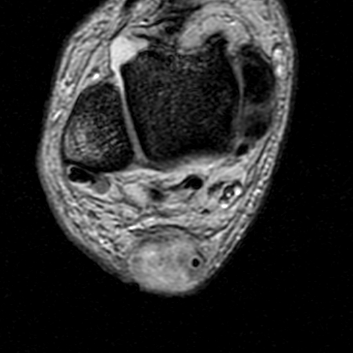 File:Chronic Achilles tendon rupture (Radiopaedia 15262-15100 Axial Gradient Echo 13).jpg