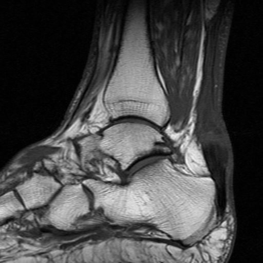 File:Chronic Achilles tendon rupture (Radiopaedia 15262-15100 Sagittal T1 6).jpg