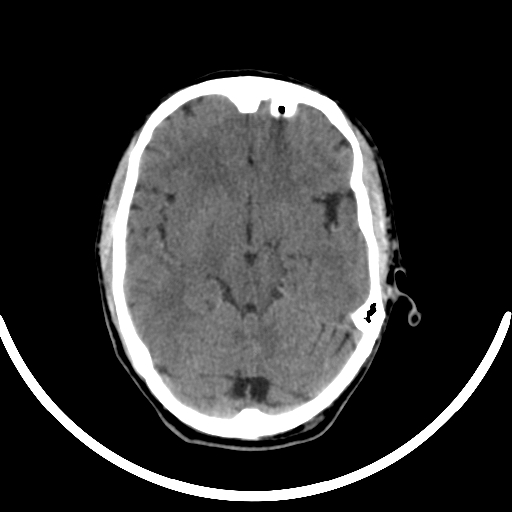 Chronic invasive fungal sinusitis with intraorbital and intracranial extension (Radiopaedia 56387-63046 Axial non-contrast 173).jpg