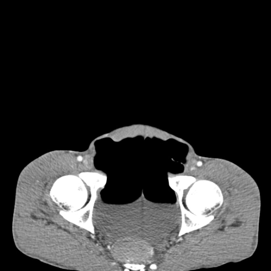 File:Chronic large bowel pseudo-obstruction (Radiopaedia 43181-46492 A 154).jpg