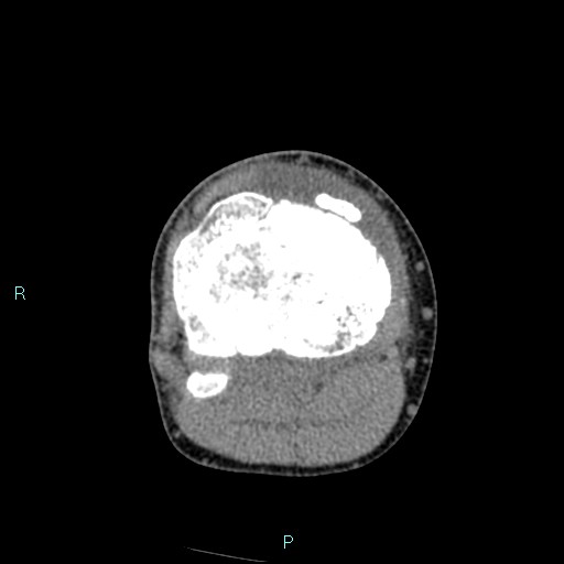 Chronic osteomyelitis (with Brodie abscess) (Radiopaedia 76405-88111 A 92).jpg