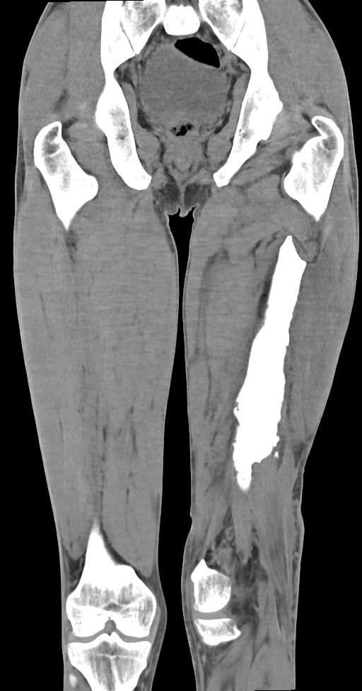 Chronic osteomyelitis (with sequestrum) (Radiopaedia 74813-85822 E 35).jpg