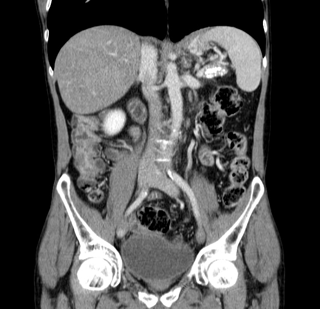 Chronic pancreatitis (Radiopaedia 23132-23172 C 33).jpg