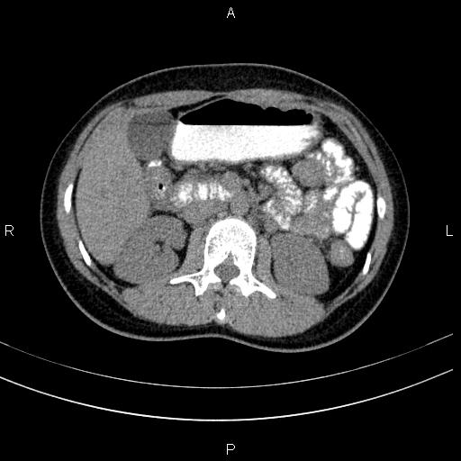 Chronic pancreatitis (Radiopaedia 64576-73450 Axial non-contrast 62).jpg