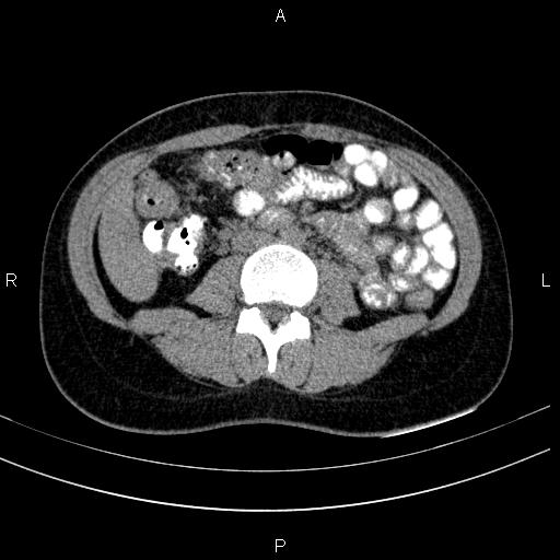 Chronic pancreatitis (Radiopaedia 64576-73450 Axial non-contrast 88).jpg