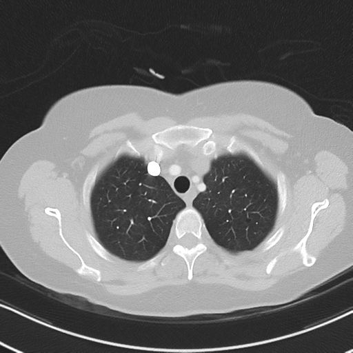 Chronic pulmonary embolus (Radiopaedia 39129-41341 Axial lung window 14).png