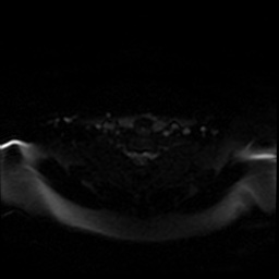 File:Chronic submandibular sialadenitis (Radiopaedia 61852-69885 Axial DWI 54).jpg