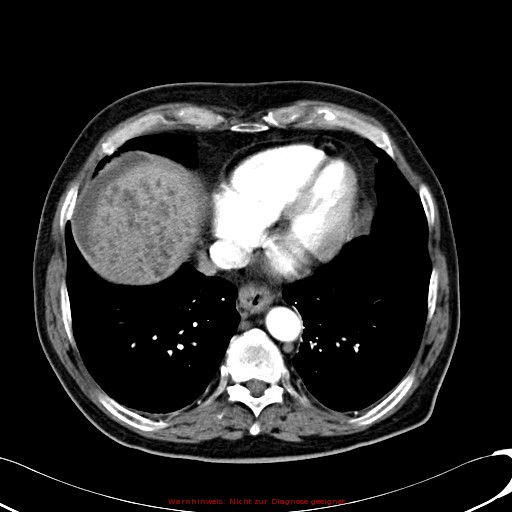 File:Cirrhosis and hepatocellular carcinoma in the setting of hemochromatosis (Radiopaedia 75394-86595 A 15).jpg