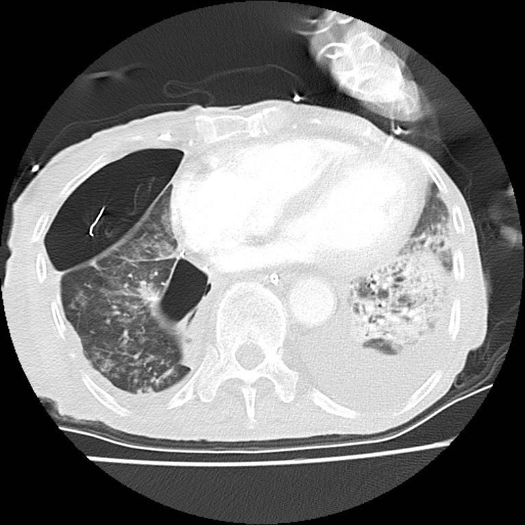 Clagett thoracotomy with bronchopleural fistula (Radiopaedia 29192-29587 Axial lung window 35).jpg